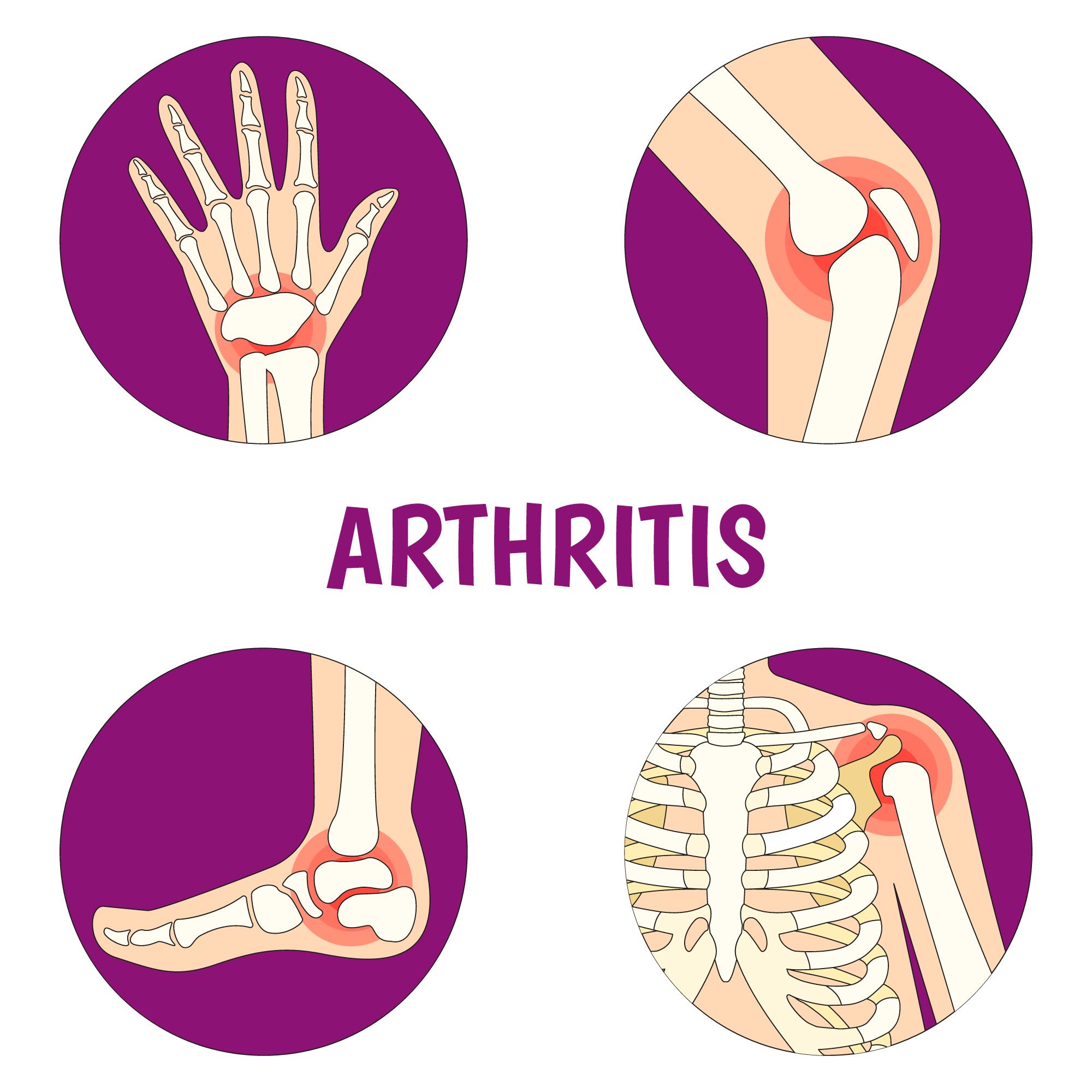 arthritis illustration: pain in hand, knee, ankle, shoulder